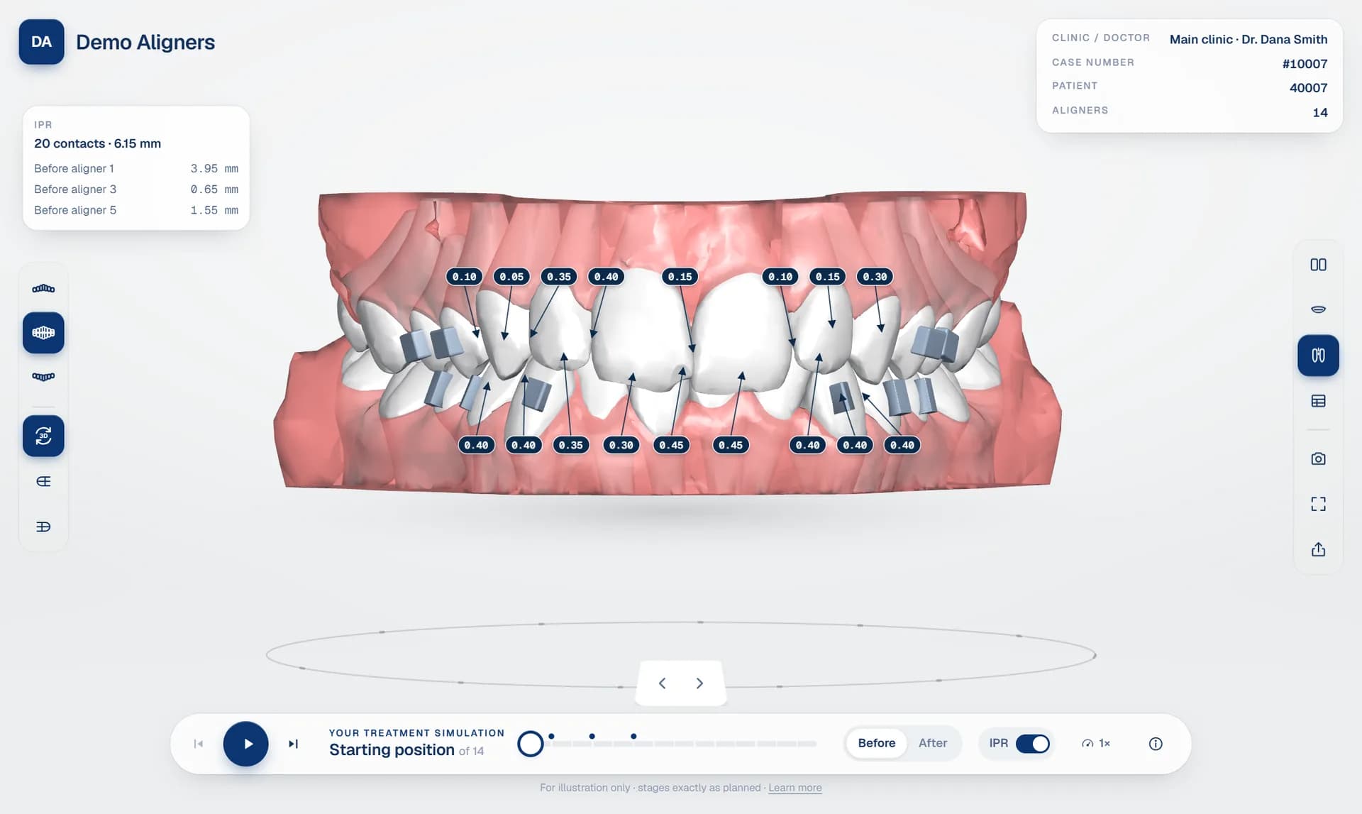 Aligner treatment simulation software showing a 3D treatment plan with IPR values